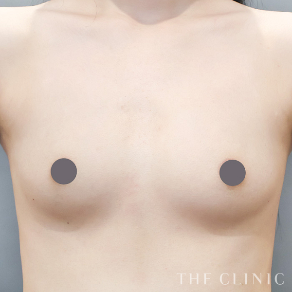 ボリュームアップのコンデンスリッチ豊胸（23歳女性）の術前写真