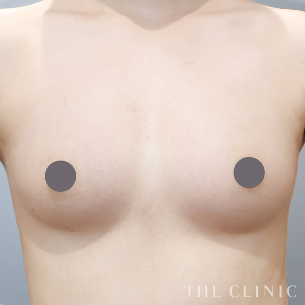 ボリュームアップのコンデンスリッチ豊胸（23歳女性）の術後写真