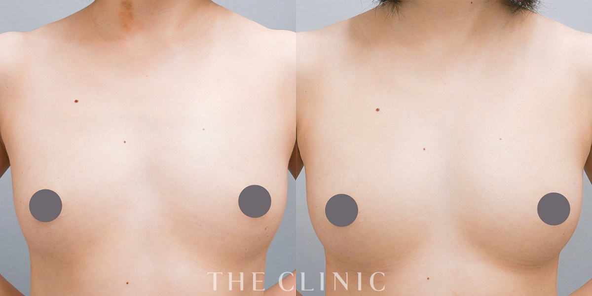 コンデンスリッチ豊胸の術前／術後