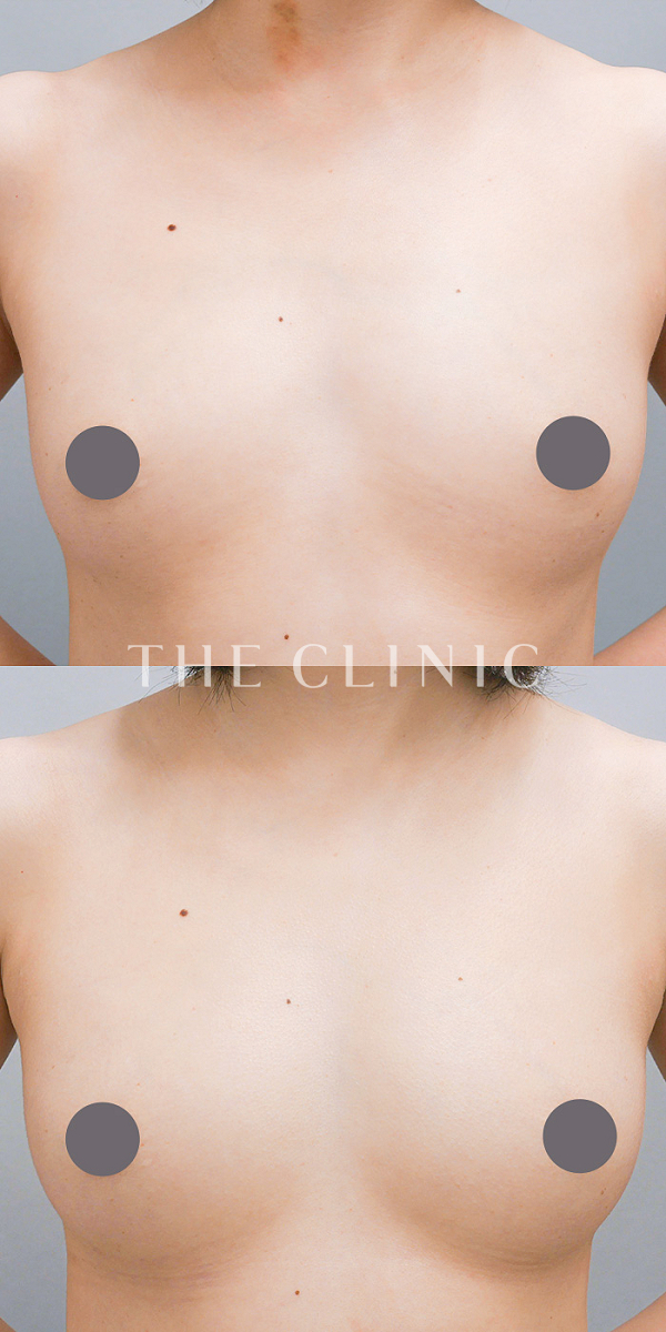 ボリュームアップのコンデンスリッチ豊胸（28歳女性）の術前・術後写真