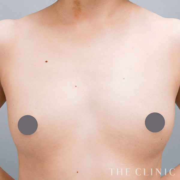 ボリュームアップのコンデンスリッチ豊胸（28歳女性）の術前写真