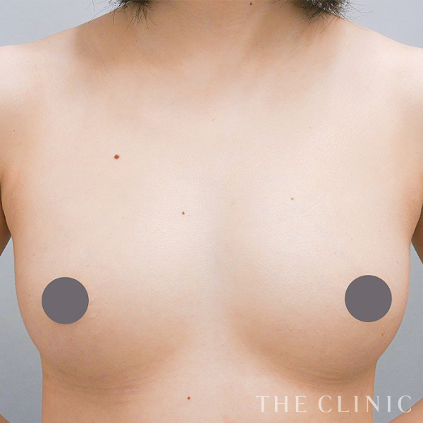 ボリュームアップのコンデンスリッチ豊胸（28歳女性）の術後写真