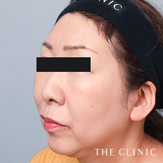 【THE CLINIC 症例画像】No.1584_2_額のシワ_コンデンスリッチフェイス(顔の脂肪注入)(執刀医:)
