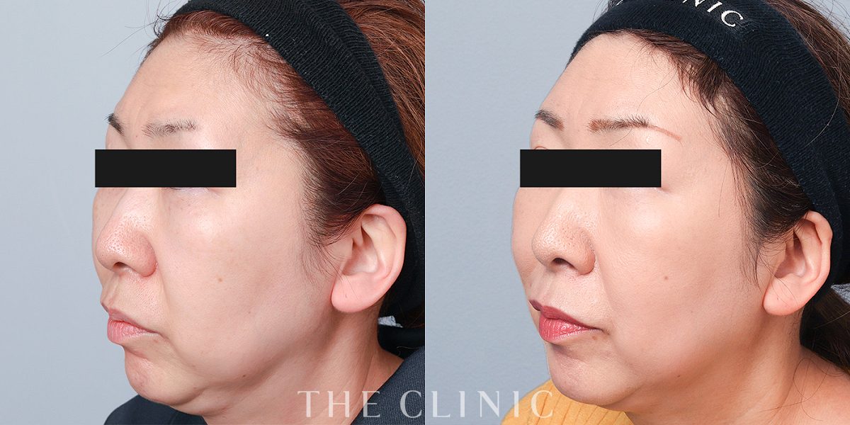 コンデンスリッチフェイス(顔の脂肪注入)の術前／術後