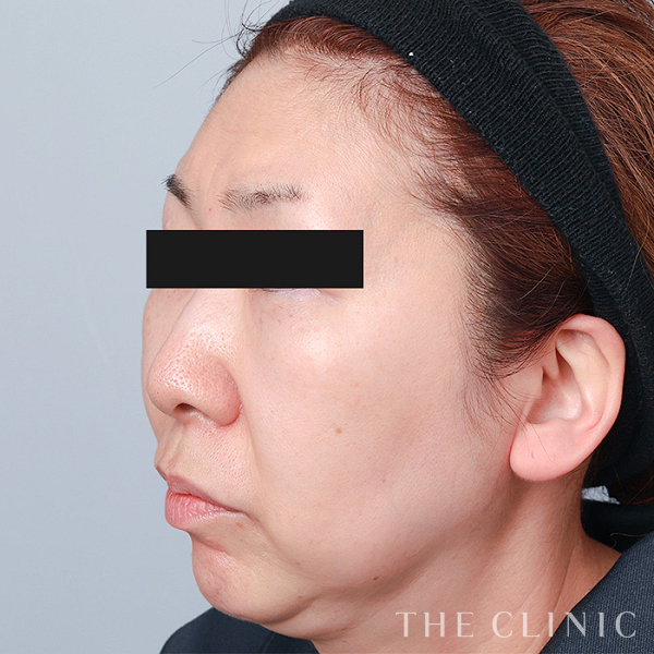 額のシワ・眉間のシワ・こめかみのコンデンスリッチフェイス(顔の脂肪注入)（55歳女性）の術前写真