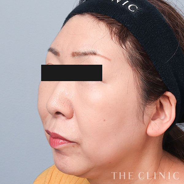 額のシワ・眉間のシワ・こめかみのコンデンスリッチフェイス(顔の脂肪注入)（55歳女性）の術後写真