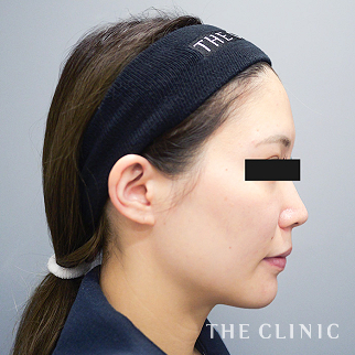 【THE CLINIC 症例画像】No.1585_1_おでこ(額)のくぼみ_コンデンスリッチフェイス(顔の脂肪注入)