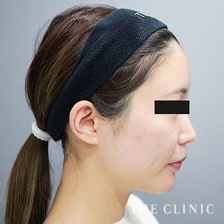 【THE CLINIC 症例画像】No.1585_2_おでこ(額)のくぼみ_コンデンスリッチフェイス(顔の脂肪注入)