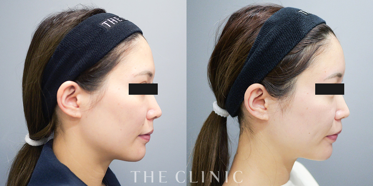 コンデンスリッチフェイス(顔の脂肪注入)の術前/術後