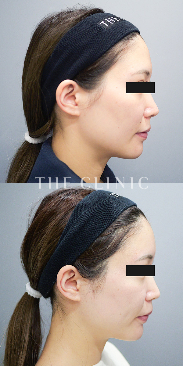 おでこ(額)のくぼみのコンデンスリッチフェイス(顔の脂肪注入)（31歳女性）の術前・術後写真