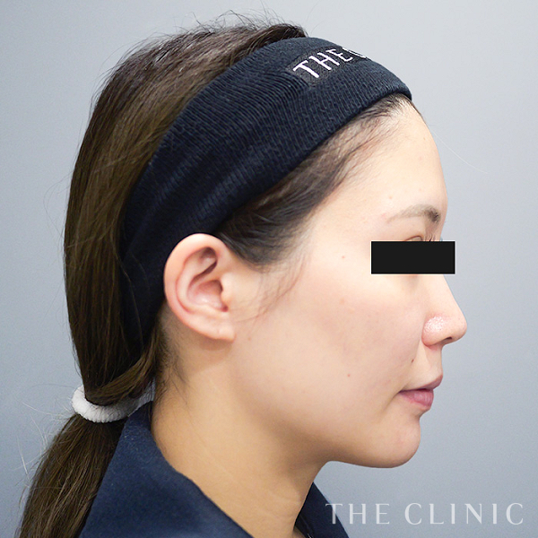 おでこ(額)のくぼみのコンデンスリッチフェイス(顔の脂肪注入)（31歳女性）の術前写真