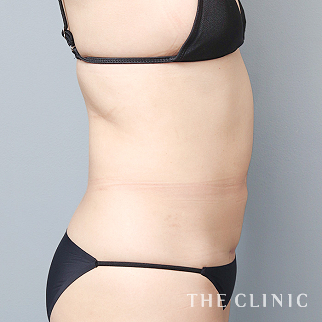 【THE CLINIC 症例画像】No.1586_2_腹部_360脂肪吸引®