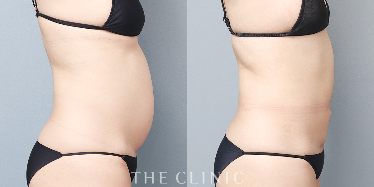 ベイザー脂肪吸引の術前／術後