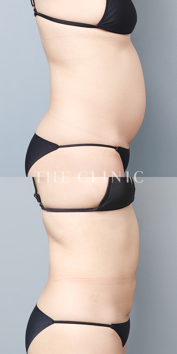 腹部のベイザー脂肪吸引（46歳女性）の術前・術後写真