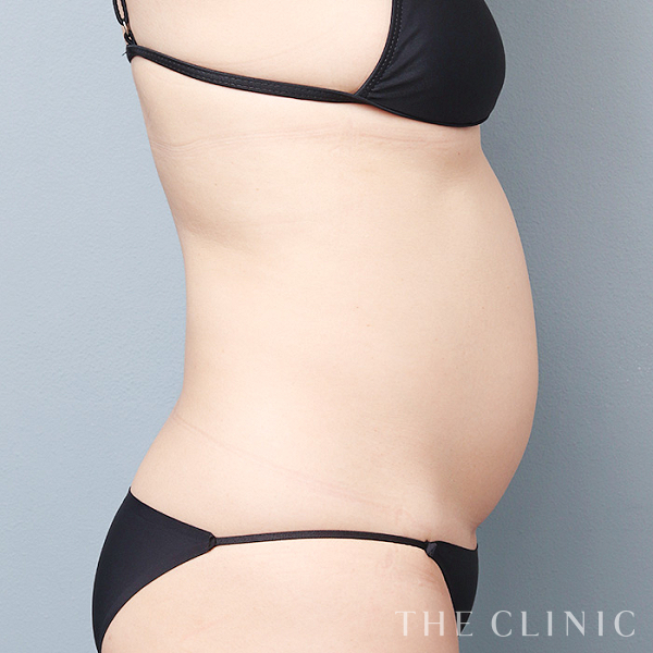 腹部のベイザー脂肪吸引（46歳女性）の術前写真