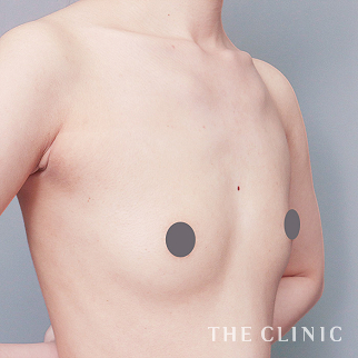 【THE CLINIC 症例画像】No.1587_1_ボリュームアップ_コンデンスリッチ豊胸