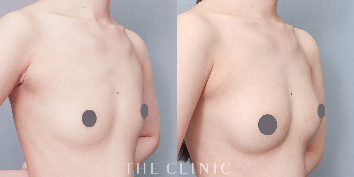 コンデンスリッチ豊胸の術前／術後