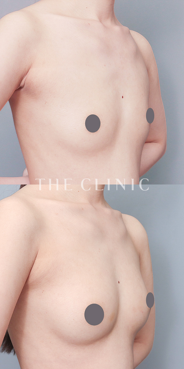 ボリュームアップのコンデンスリッチ豊胸（22歳女性）の術前・術後写真