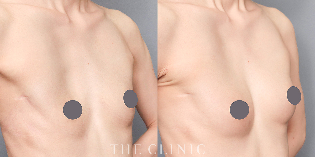 コンデンスリッチ豊胸の術前／術後