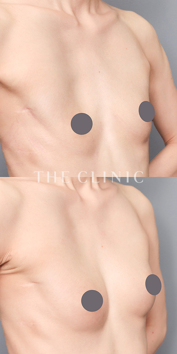 ボリュームアップのコンデンスリッチ豊胸（33歳女性）の術前・術後写真