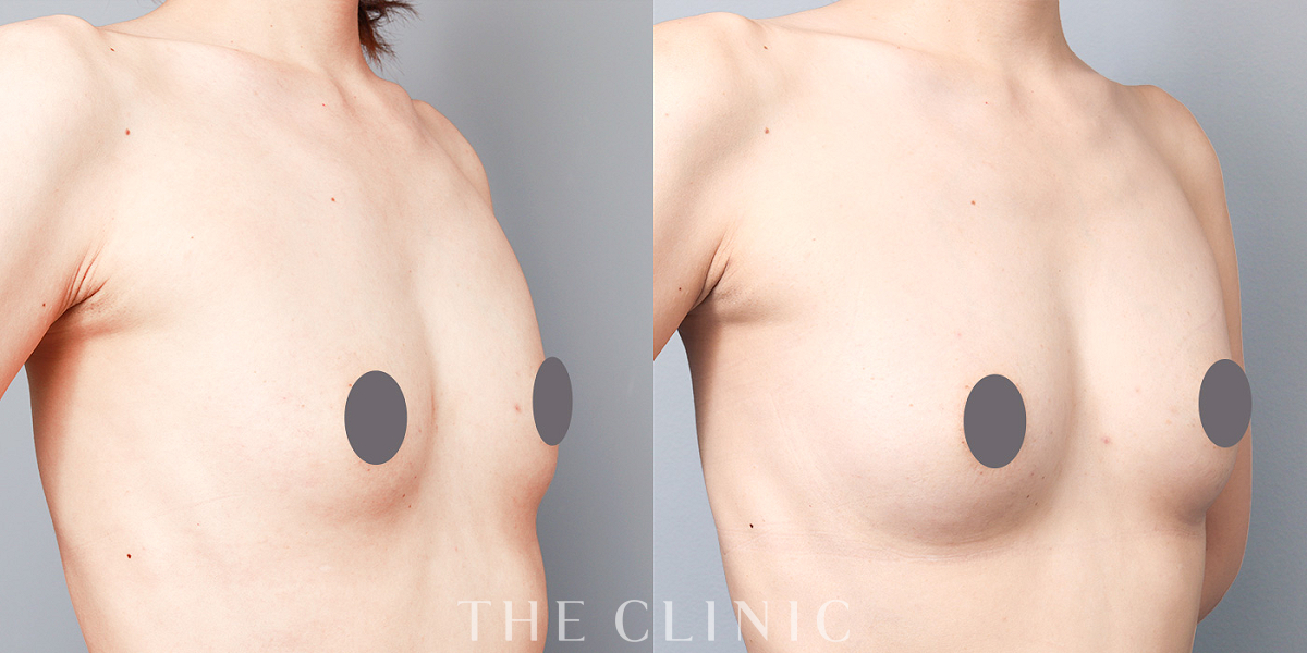 上向きバスト豊胸の術前／術後