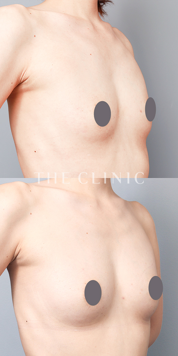 ボリュームアップの上向きバスト豊胸（39歳女性）の術前・術後写真