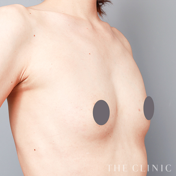 ボリュームアップの上向きバスト豊胸（39歳女性）の術前写真