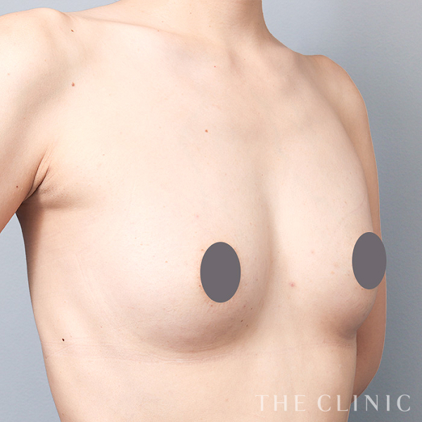 ボリュームアップの上向きバスト豊胸（39歳女性）の術後写真