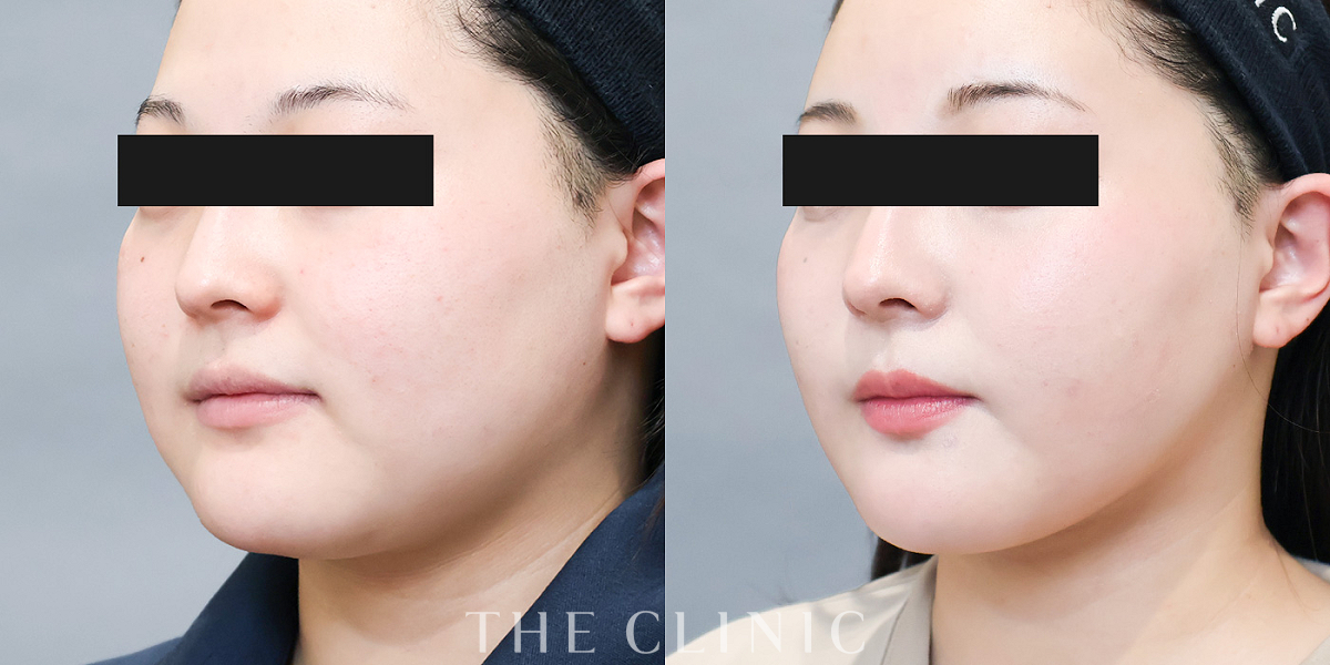 ベイザー脂肪吸引の術前／術後