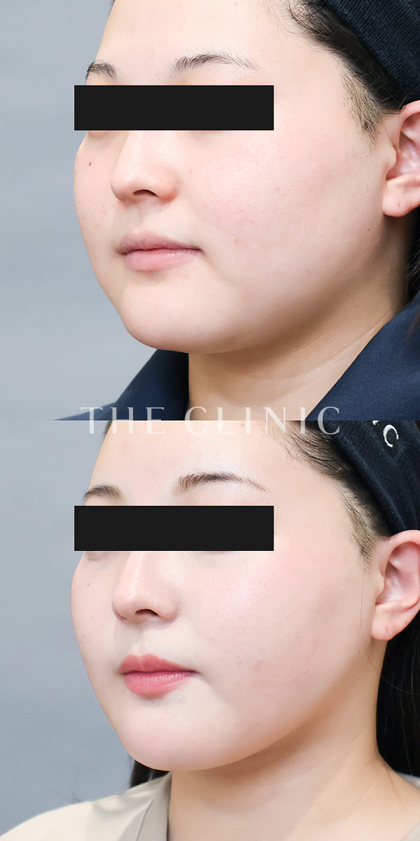 頰／顎のベイザー脂肪吸引（23歳女性）の術前・術後写真