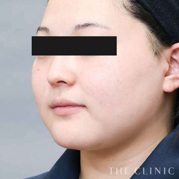頰／顎のベイザー脂肪吸引（23歳女性）の術前写真