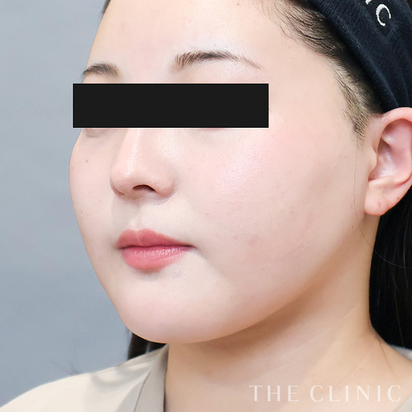 頰／顎のベイザー脂肪吸引（23歳女性）の術後写真