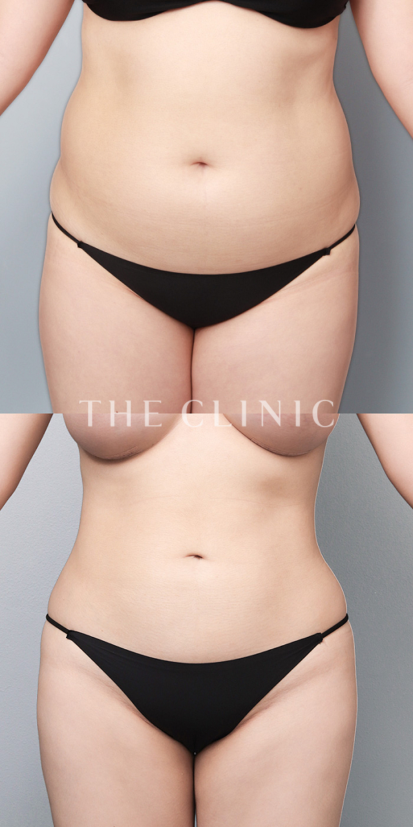 腹部の360°脂肪吸引（26歳女性）の術前・術後写真