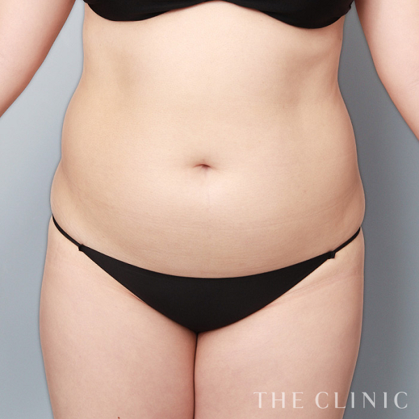 腹部の360°脂肪吸引（26歳女性）の術前写真