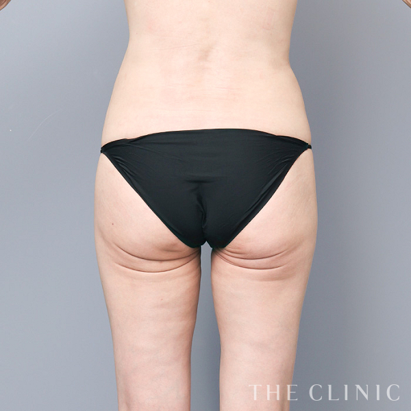 太もものモフィウスボディ（59歳女性）の術後写真