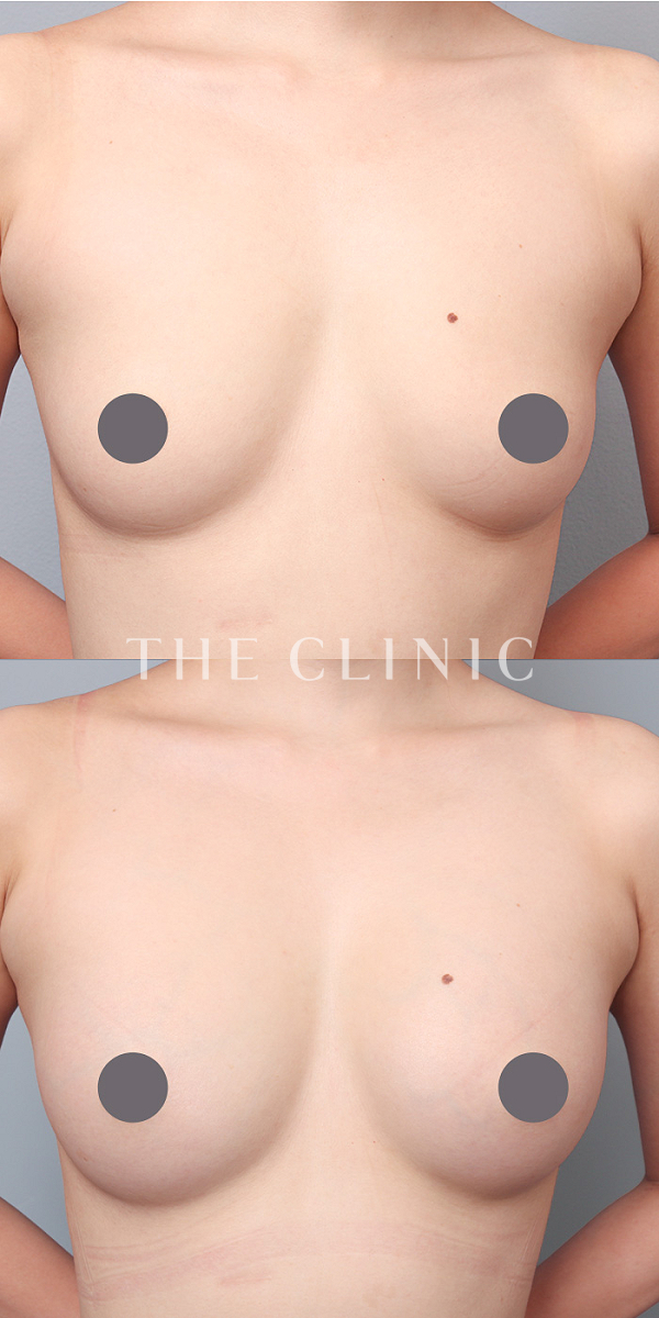 ボリュームアップのコンデンスリッチ豊胸（29歳女性）の術前・術後写真