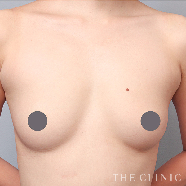 ボリュームアップのコンデンスリッチ豊胸（29歳女性）の術前写真