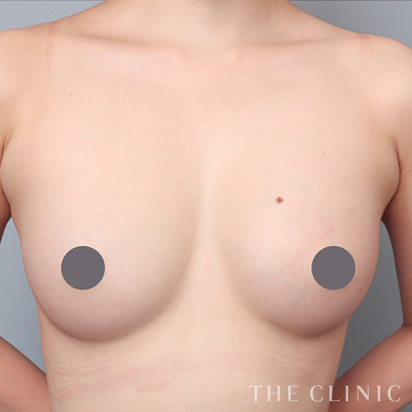 ボリュームアップのコンデンスリッチ豊胸（29歳女性）の術後写真