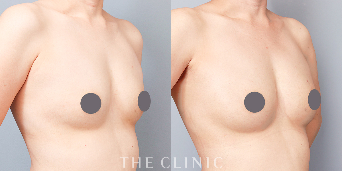 コンデンスリッチ豊胸の術前／術後
