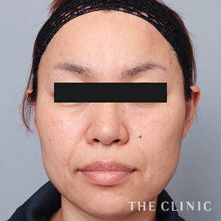 【THE CLINIC 症例画像】No.1595_1_頰/顎_マイクロCRF注入(顔の脂肪注入)(執刀医:帯包 雄次郎)