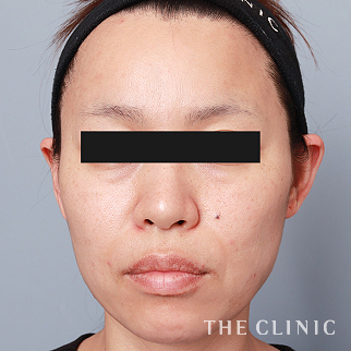 【THE CLINIC 症例画像】No.1595_2_頰/顎_マイクロCRF注入(顔の脂肪注入)(執刀医:帯包 雄次郎)