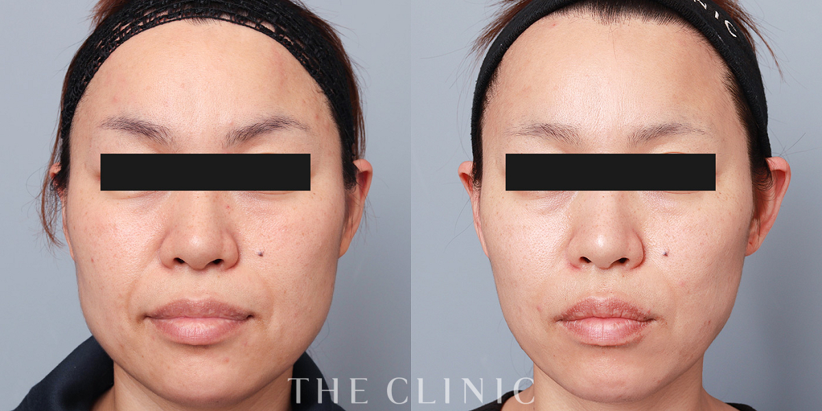 マイクロCRF注入(顔の脂肪注入)の術前/術後