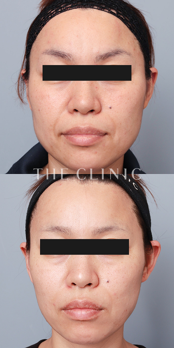 頰／顎・目の下のクマ・ゴルゴライン・法令線のマイクロCRF注入(顔の脂肪注入)（42歳女性）の術前・術後写真