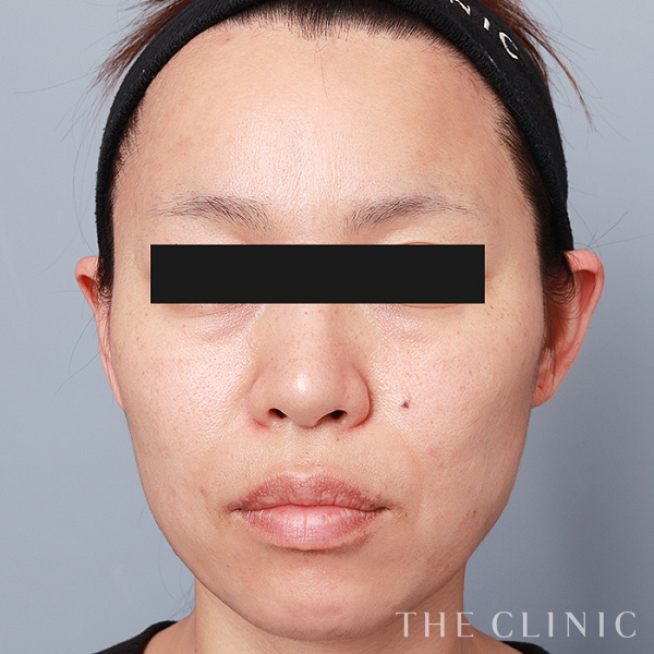 頰／顎・目の下のクマ・ゴルゴライン・法令線のマイクロCRF注入(顔の脂肪注入)（42歳女性）の術後写真