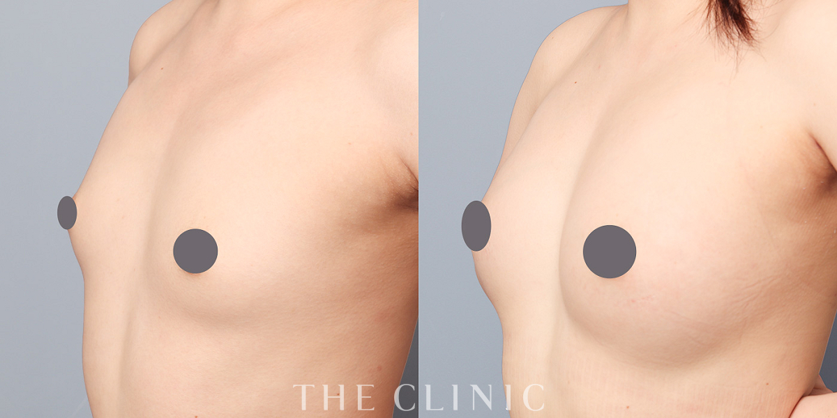 コンデンスビブラ豊胸の術前／術後