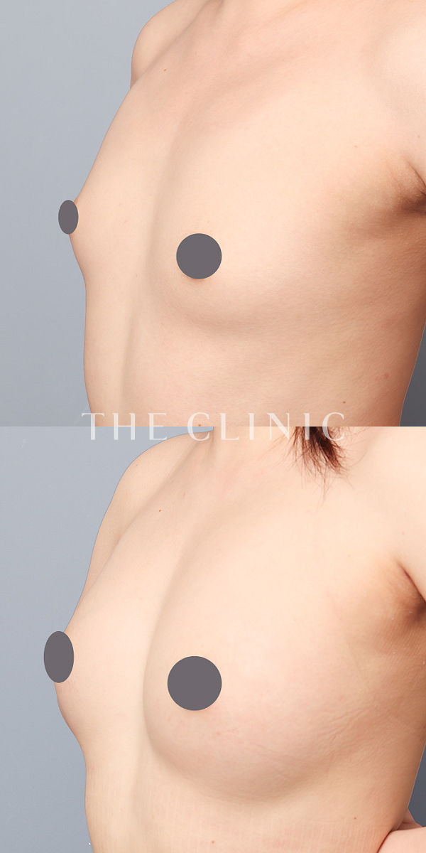 ボリュームアップのコンデンスビブラ豊胸（53歳女性）の術前・術後写真