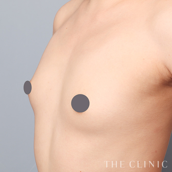 ボリュームアップのコンデンスビブラ豊胸（53歳女性）の術前写真