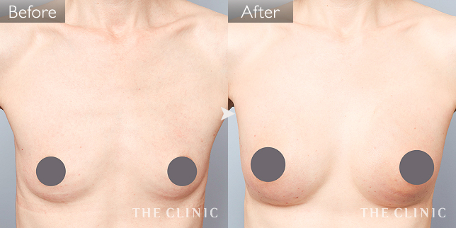 豊胸・胸の整形 ボリュームアップ 症例写真