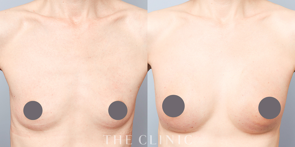 コンデンスビブラ豊胸の術前／術後