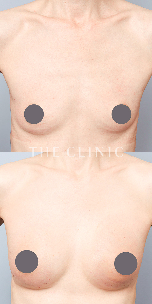 ボリュームアップのコンデンスビブラ豊胸（51歳女性）の術前・術後写真